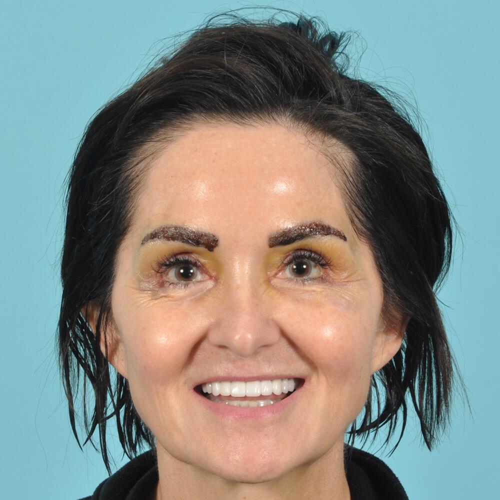 NeoGraft - Eyebrow Before & After Image