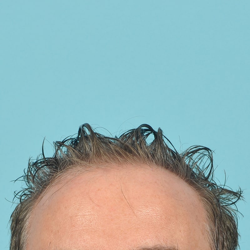 NeoGraft - Hair Restoration Before & After Image