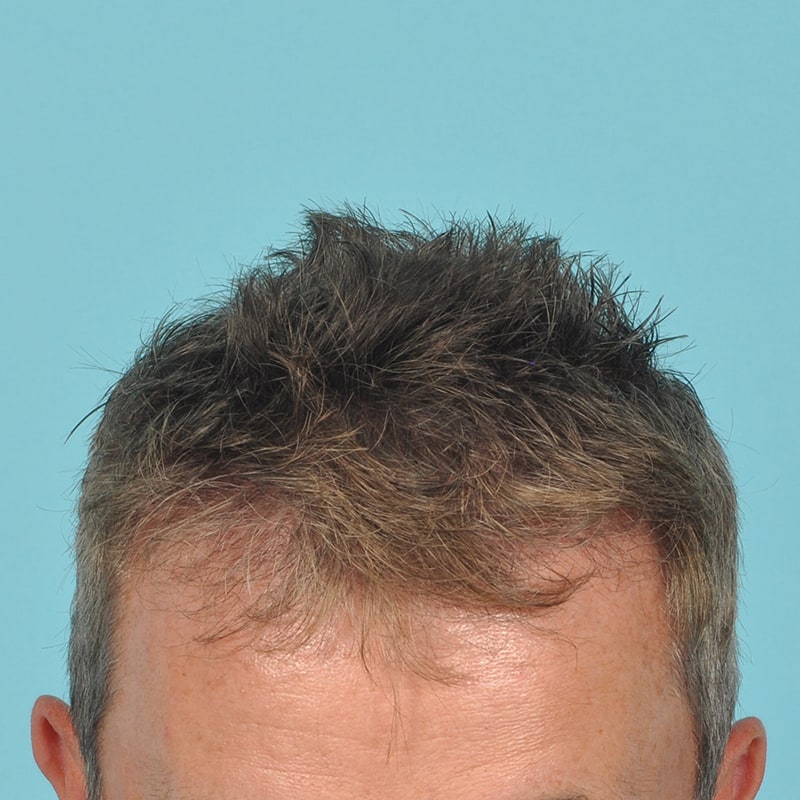 NeoGraft - Hair Restoration Before & After Image