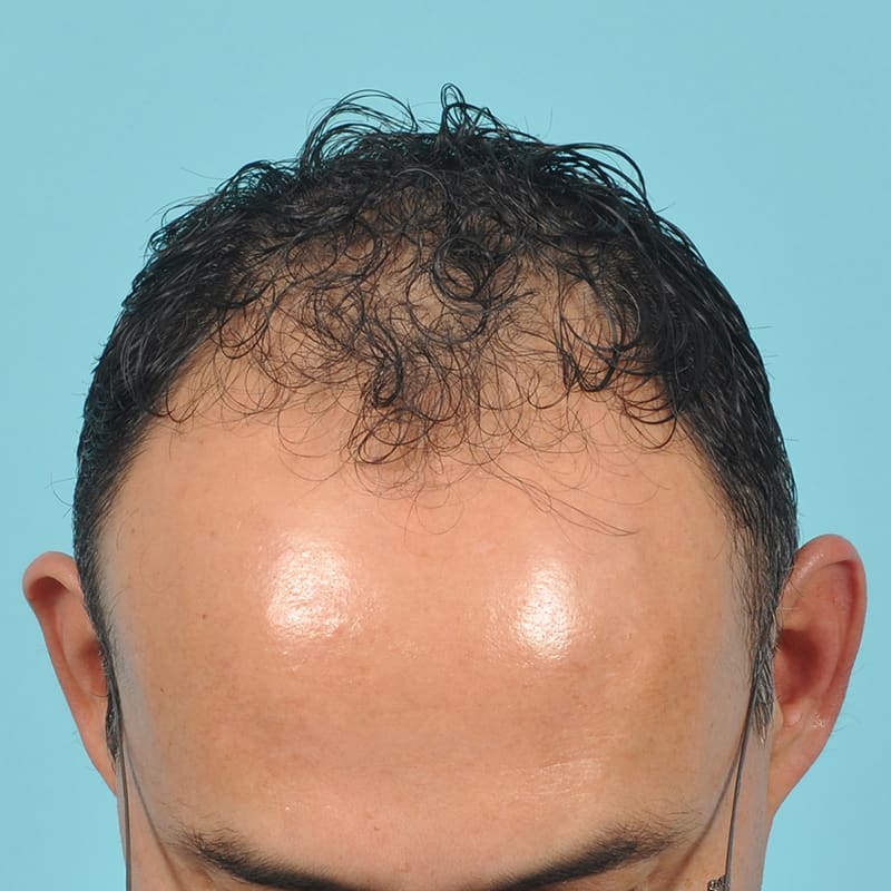 NeoGraft - Hair Restoration Before & After Image