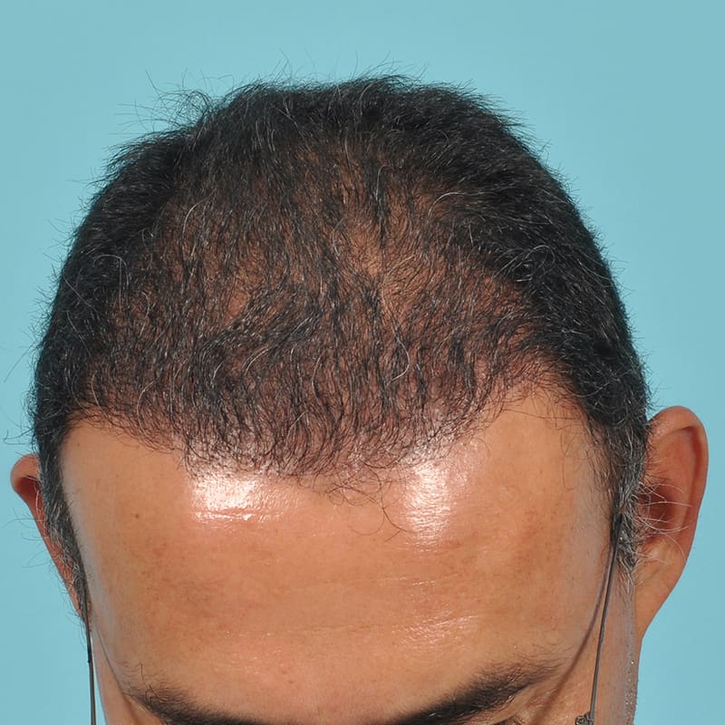 NeoGraft - Hair Restoration Before & After Image