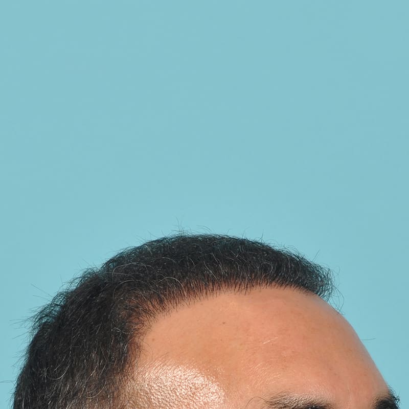 NeoGraft - Hair Restoration Before & After Image