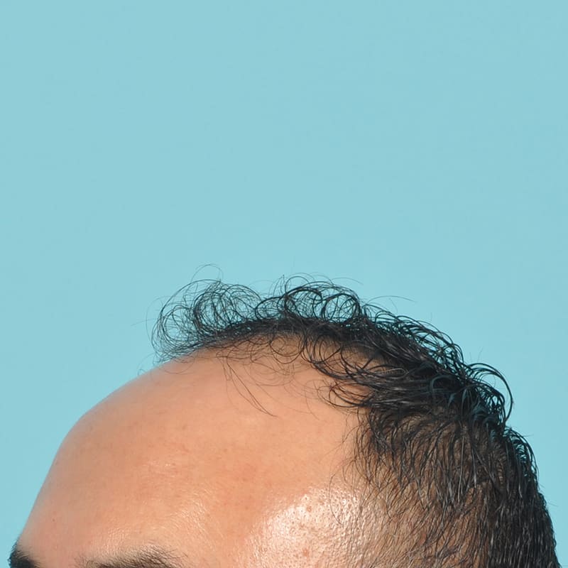 NeoGraft - Hair Restoration Before & After Image