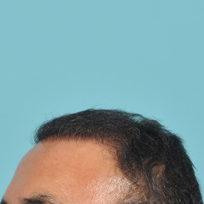 NeoGraft - Hair Restoration Before & After Image