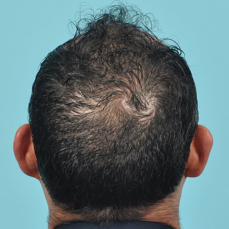 NeoGraft - Hair Restoration Before & After Image