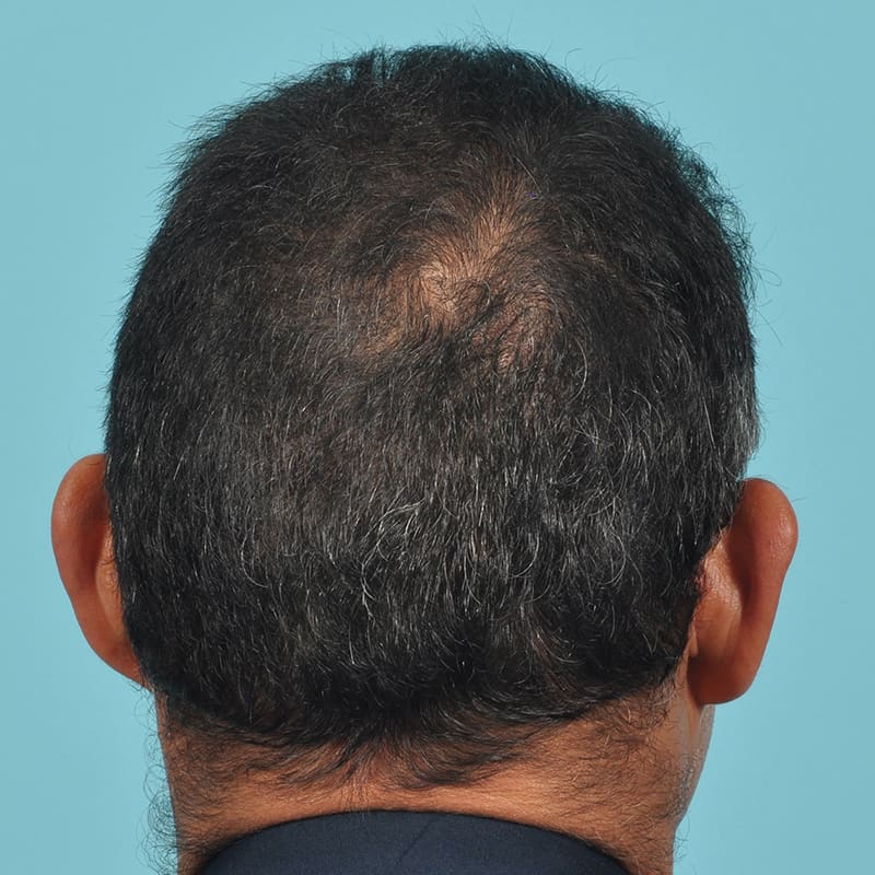 NeoGraft - Hair Restoration Before & After Image