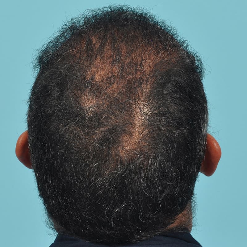 NeoGraft - Hair Restoration Before & After Image