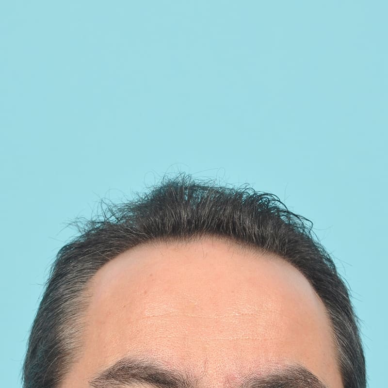 NeoGraft - Hair Restoration Before & After Image