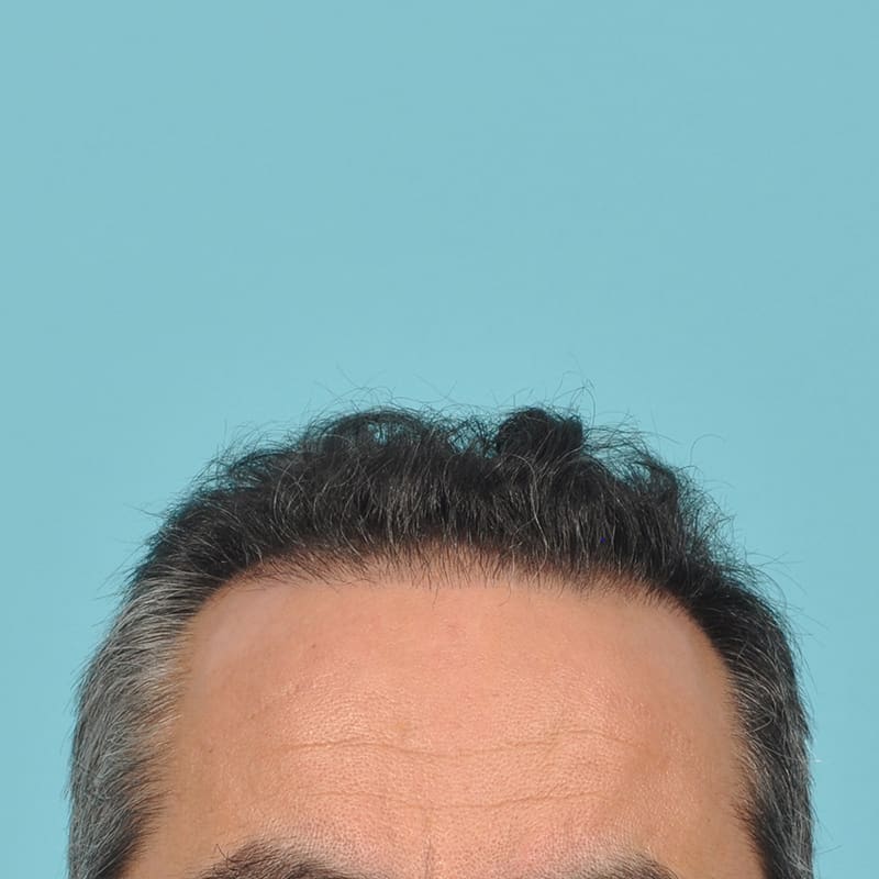 NeoGraft - Hair Restoration Before & After Image