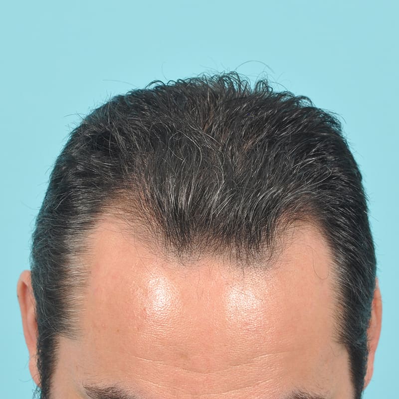 NeoGraft - Hair Restoration Before & After Image