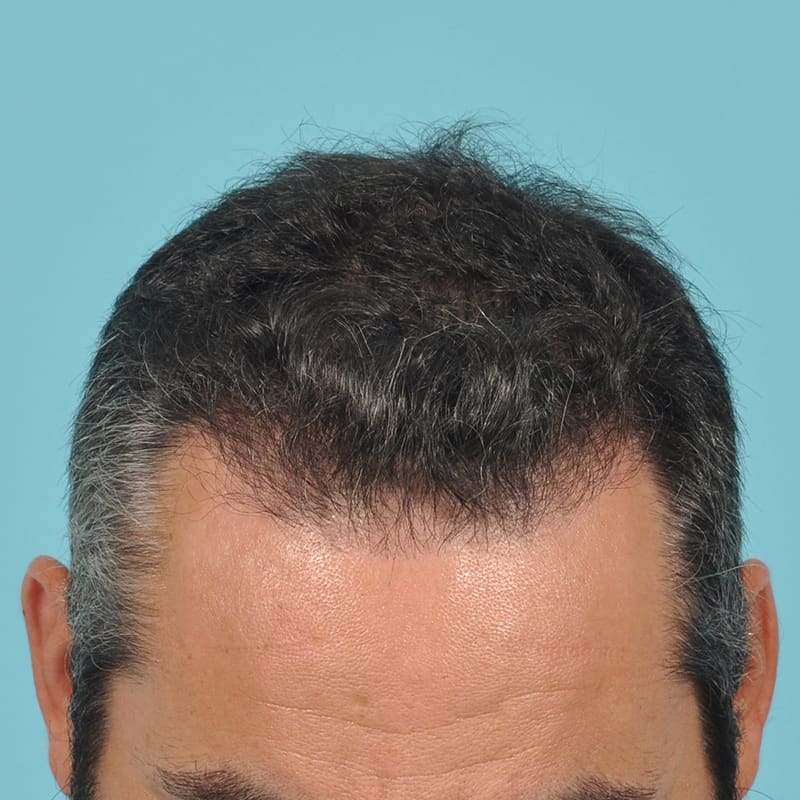 NeoGraft - Hair Restoration Before & After Image