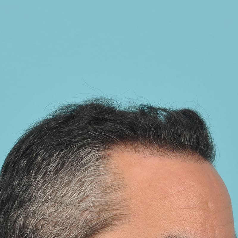 NeoGraft - Hair Restoration Before & After Image