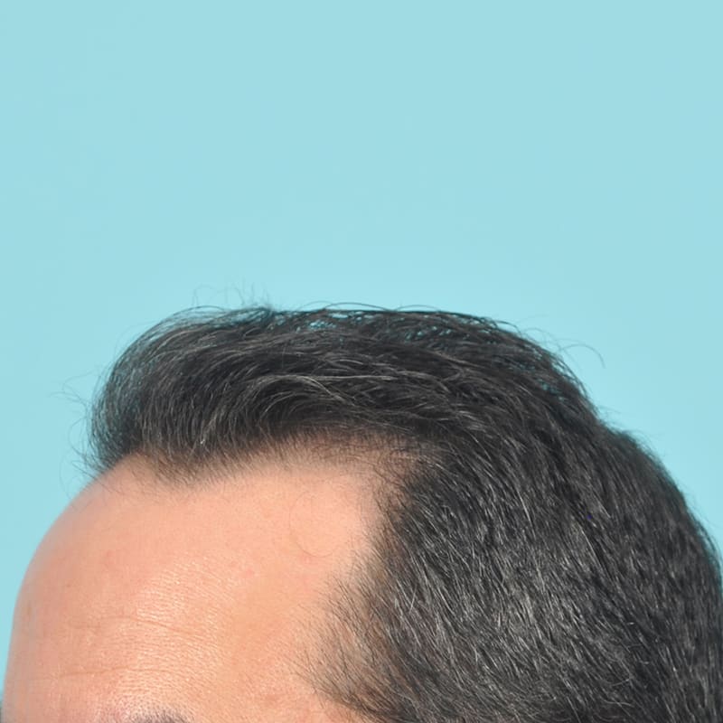 NeoGraft - Hair Restoration Before & After Image