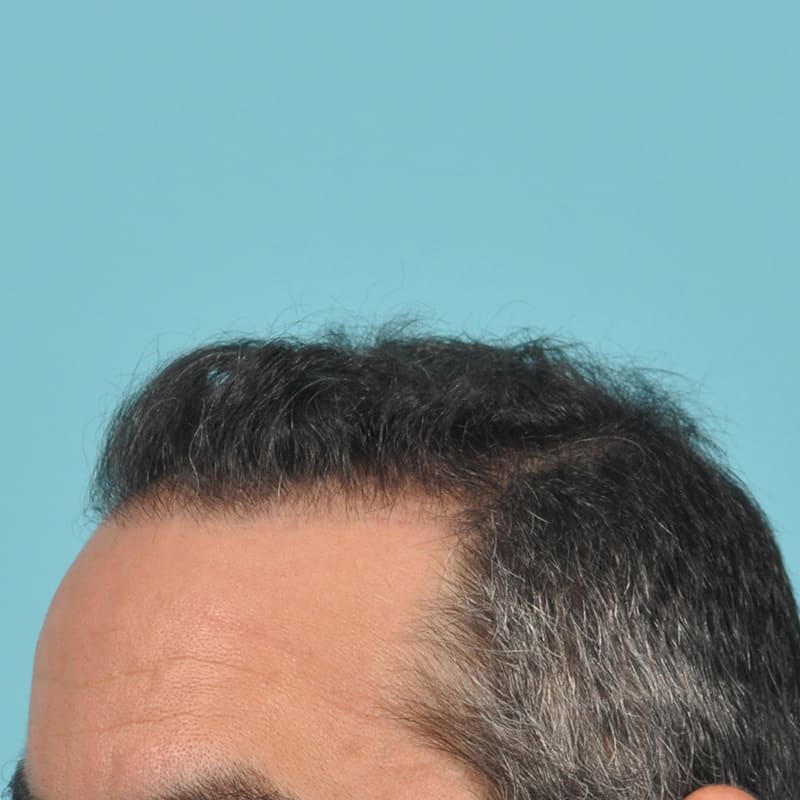 NeoGraft - Hair Restoration Before & After Image