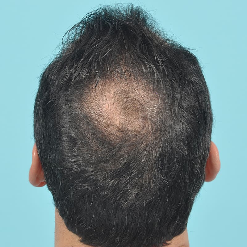 NeoGraft - Hair Restoration Before & After Image