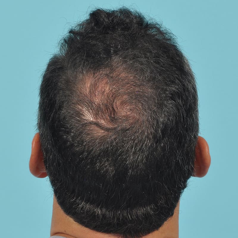 NeoGraft - Hair Restoration Before & After Image